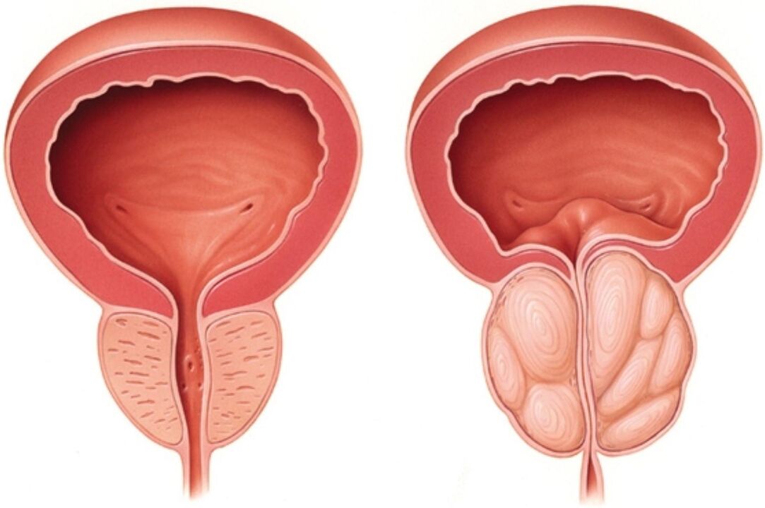 Normal prostate (left) and prostatitis with inflammatory symptoms (right)