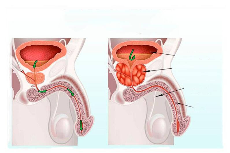 the prostate norm and inflammation
